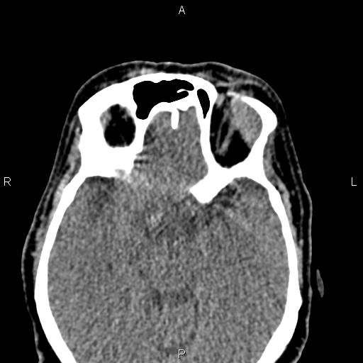Bilateral enlargement of lacrimal glands - sarcoidosis (Radiopaedia 62627-70921 Axial non-contrast 61).jpg