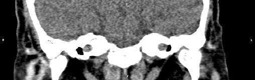 File:Bilateral enlargement of lacrimal glands - sarcoidosis (Radiopaedia 62627-70921 Coronal non-contrast 32).jpg