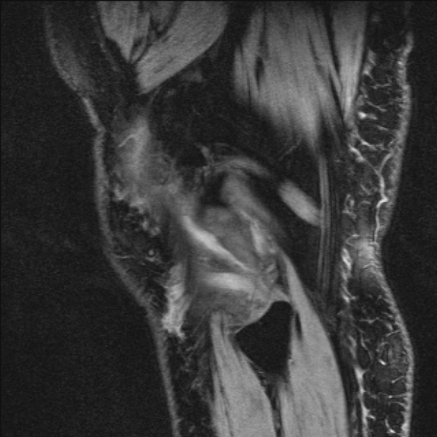 Bilateral focal pigmented villonodular synovitis (Radiopaedia 67643-77046 G 56).jpg