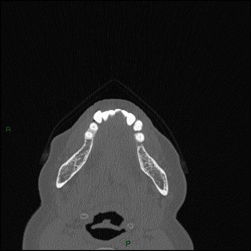 Bilateral frontal mucoceles (Radiopaedia 82352-96454 Axial bone window 308).jpg