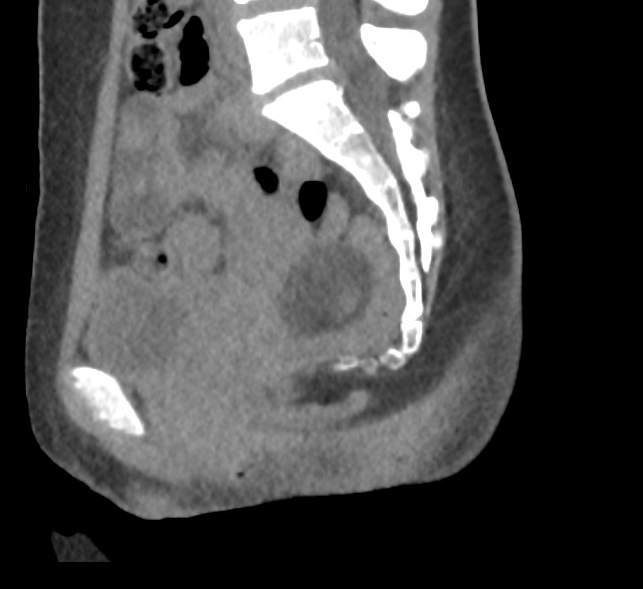 File:Bilateral mature cystic ovarian teratoma (Radiopaedia 88821-105592 D 33).jpg
