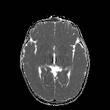 File:Bilateral mesial temporal polymicrogyria (Radiopaedia 76456-88181 Axial ADC 12).jpg