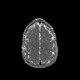 File:Bilateral mesial temporal polymicrogyria (Radiopaedia 76456-88181 Axial ADC 22).jpg