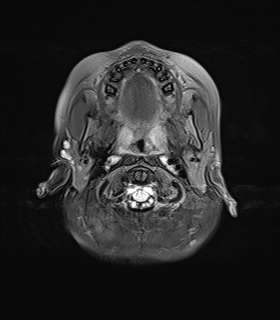 File:Bilateral mesial temporal polymicrogyria (Radiopaedia 76456-88181 Axial FLAIR 1).jpg