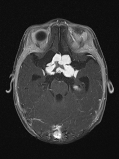 File:Bilateral optic pathway gliomas (Radiopaedia 40013-42514 Axial T1 C+ fat sat 7).jpg