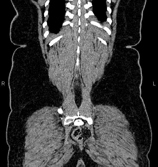 Bilateral ovarian dermoid cysts (Radiopaedia 85785-101603 C 56).jpg