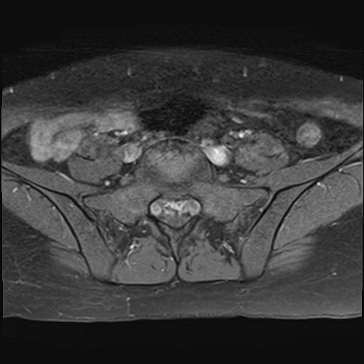 File:Bilateral ovarian endometriomas (Radiopaedia 87085-103347 Axial T1 C+ fat sat 1).jpg