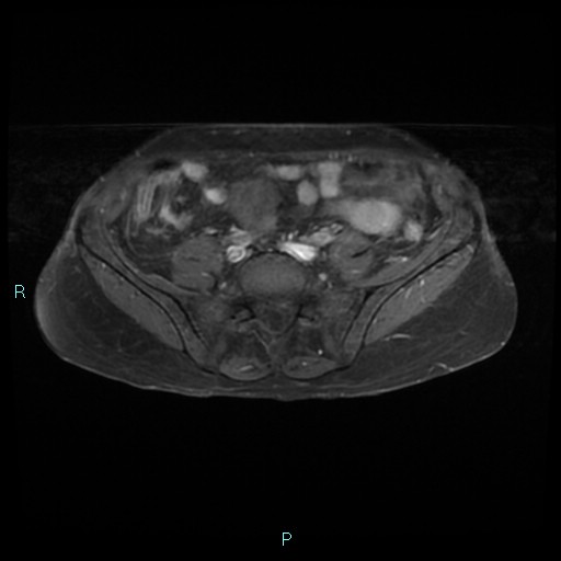 File:Bilateral ovarian fibroma (Radiopaedia 44568-48293 Axial T1 C+ fat sat 3).jpg