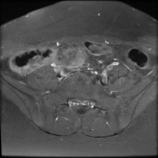 File:Bilateral ovarian fibrothecomas - adolescent (Radiopaedia 86604-102707 Axial T1 C+ fat sat 5).jpg