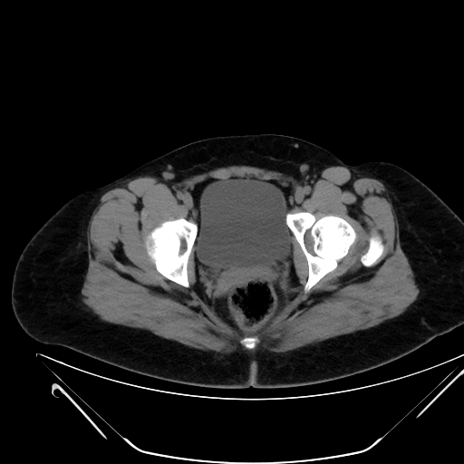 Bilateral ovarian mature cystic teratomas (Radiopaedia 79373-92457 Axial non-contrast 82).jpg