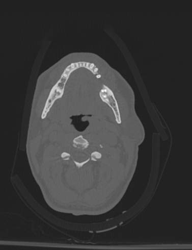 Bilateral perched facet joint (Radiopaedia 63149-71669 Axial bone window 14).jpg