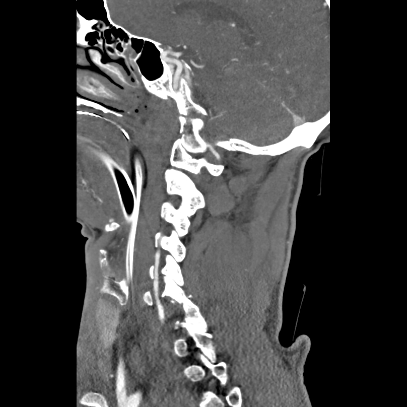Bilateral perched facets with cord injury (Radiopaedia 45587-49713 B 17).jpg
