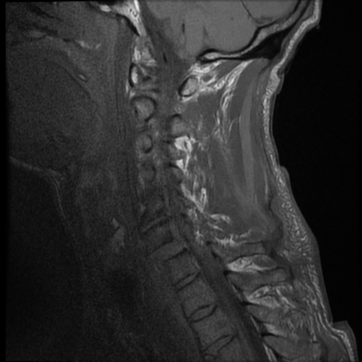 File:Bilateral perched facets with cord injury (Radiopaedia 45587-49714 Sagittal T1 5).jpg