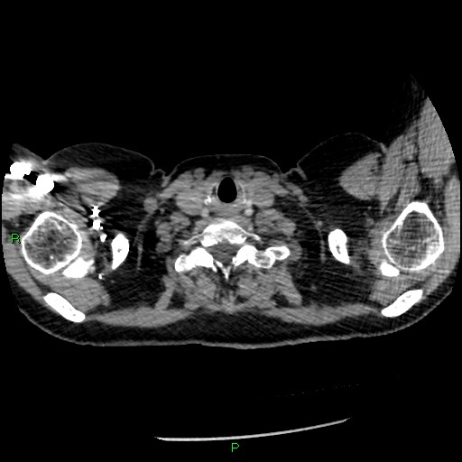Bilateral pulmonary emboli (Radiopaedia 32700-33669 Axial C+ CTPA 2).jpg
