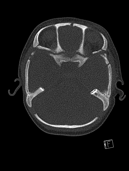 Bilateral subdural hemorrhage and parietal skull fracture (Radiopaedia 26058-26192 Axial bone window 97).png