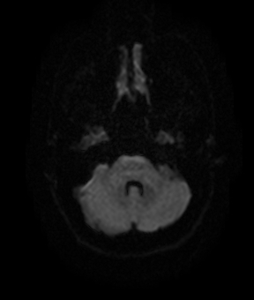 File:Bilateral thalamic gliomata (Radiopaedia 42538-45664 Axial DWI 6).jpg