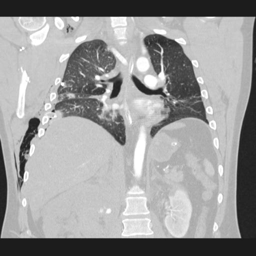 Bilateral traumatic renovascular injury (Radiopaedia 32051-32995 Coronal lung window 48).jpg