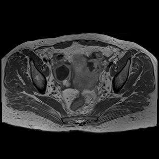 Bilateral tubo-ovarian abscesses (Radiopaedia 58635-65829 Axial T1 C+ 26).jpg