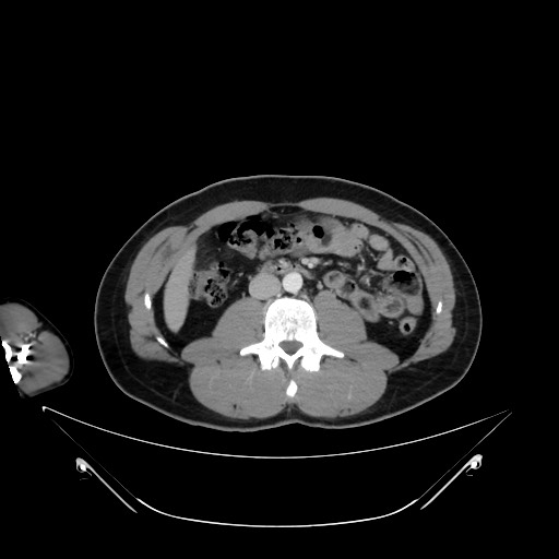 Bile leak from liver traumatic laceration (Radiopaedia 63463-72078 A 38).jpg