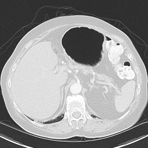 File:Bladder and bowel cancers (Radiopaedia 37688-39592 Axial lung window 51).png