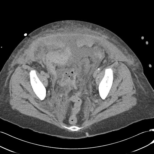Bladder rupture post renal biopsy (Radiopaedia 30863-31572 Axial non-contrast 74).jpg