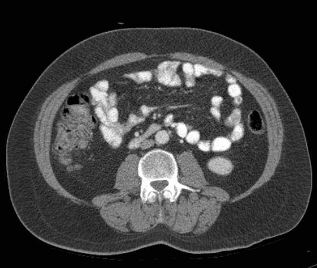 Bleeding duodenal ulcer and adenomyomatosis of gallbladder (Radiopaedia 61834-69861 A 69).jpg