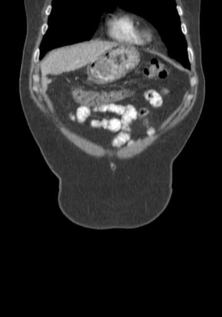 Bleeding duodenal ulcer and adenomyomatosis of gallbladder (Radiopaedia 61834-69861 B 74).jpg