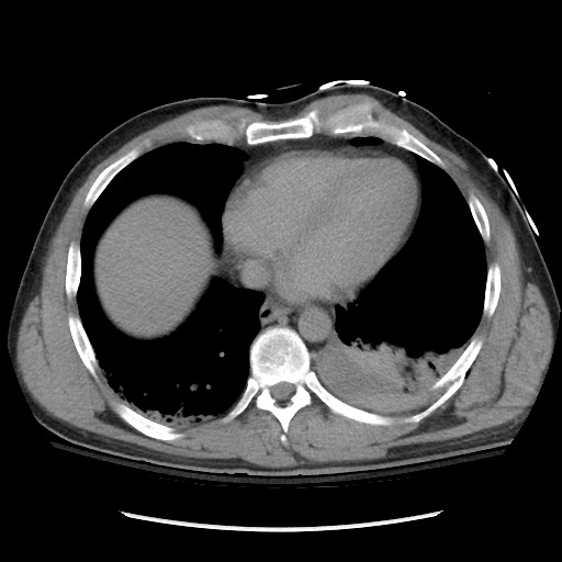 Blunt abdominal trauma with solid organ and musculoskelatal injury with active extravasation (Radiopaedia 68364-77895 Axial C+ delayed 11).jpg