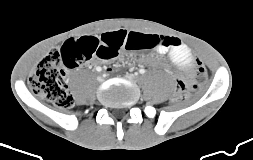 Blunt injury to the small bowel (Radiopaedia 74953-85987 A 126).jpg