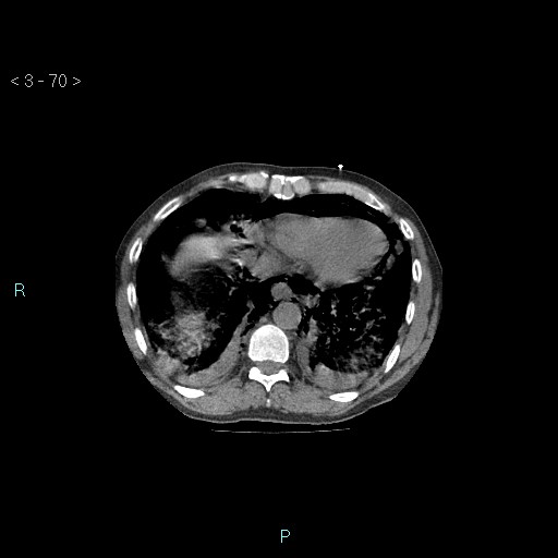 Boerhaave syndrome (Radiopaedia 27683-27897 Axial non-contrast 70).jpg