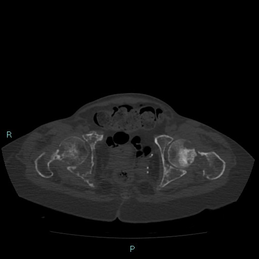Bone metastases from untreated breast cancer (Radiopaedia 42973-46219 Axial bone window 185).jpg