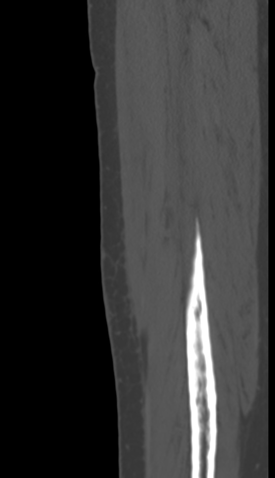 Bone metastasis - tibia (Radiopaedia 57665-64609 Sagittal bone window 149).jpg