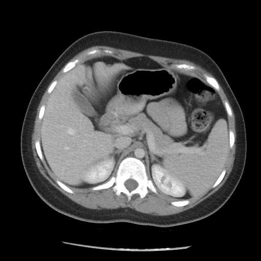 File:Borderline mucinous tumor (ovary) (Radiopaedia 78228-90808 A 75).jpg