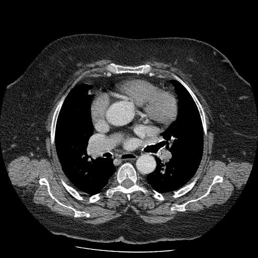 Bovine aortic arch - right internal mammary vein drains into the superior vena cava (Radiopaedia 63296-71875 A 72).jpg