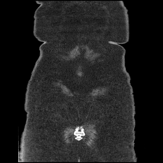 Bowel and splenic infarcts in acute lymphocytic leukemia (Radiopaedia 61055-68913 B 57).jpg