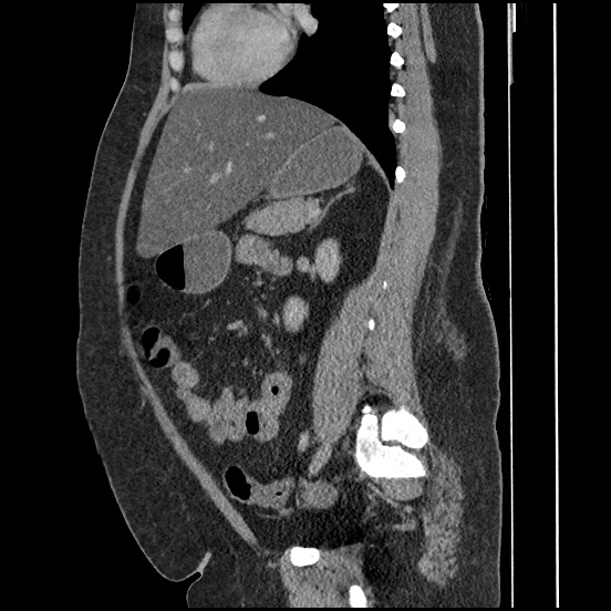 File:Bowel and splenic infarcts in acute lymphocytic leukemia (Radiopaedia 61055-68913 C 35).jpg