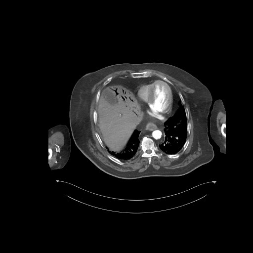 File:Bowel ischemia secondary to SMA occlusion with extensive portomesenteric venous gas (Radiopaedia 54656-60871 A 71).jpg
