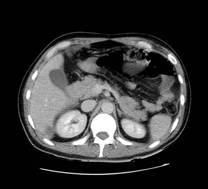 Bowel obstruction from colon carcinoma (Radiopaedia 22995-23028 A 24).jpg