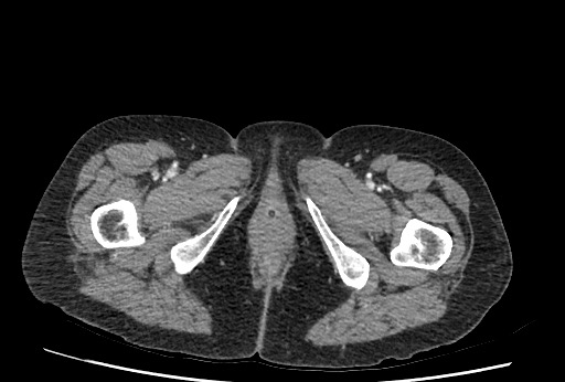 Bowel perforation at ERCP (Radiopaedia 59094-66394 C 74).jpg
