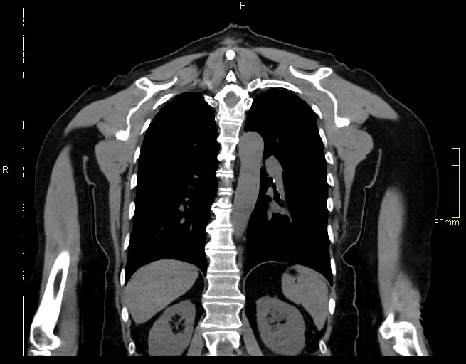 Brachial artery foreign body (Radiopaedia 54583-60820 Coronal non-contrast 41).jpg