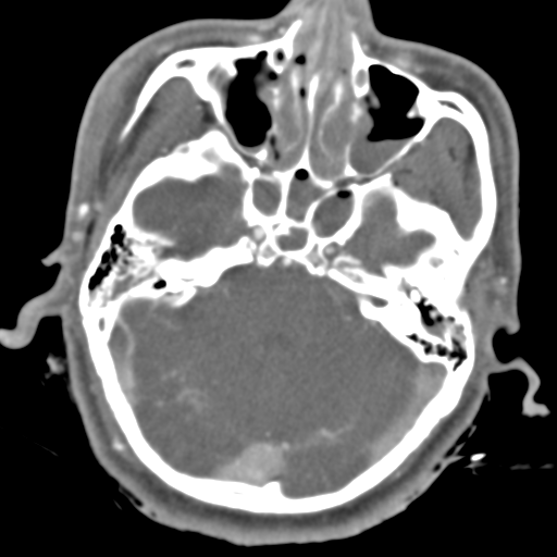 File:Brain contusions, internal carotid artery dissection and base of skull fracture (Radiopaedia 34089-35339 D 40).png