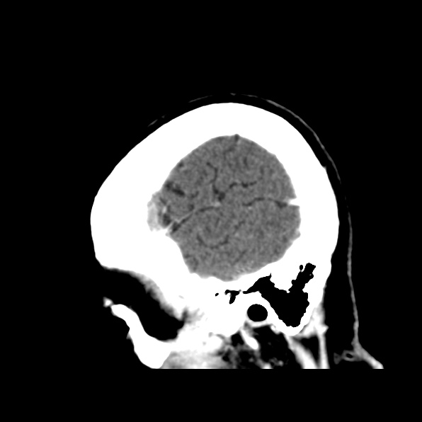 File:Brain metastases from breast cancer (Radiopaedia 23178-23231 C 41).jpg