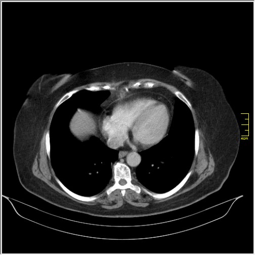 Breast cancer on thorax CT (Radiopaedia 60571-68275 A 74).JPG