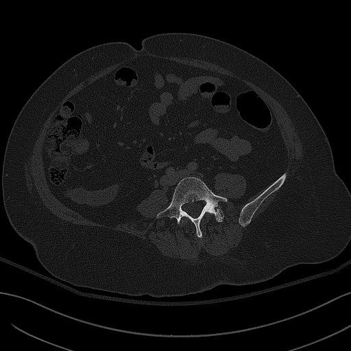 File:Breast carcinoma with pathological hip fracture (Radiopaedia 60314-67993 Axial bone window 8).jpg