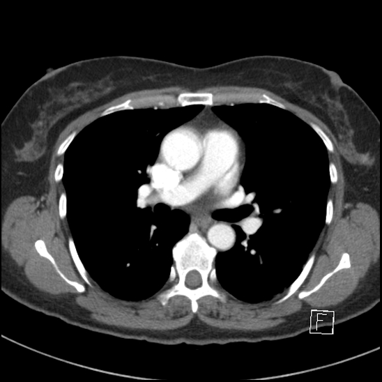 File:Breast metastases from renal cell cancer (Radiopaedia 79220-92225 A 43).jpg