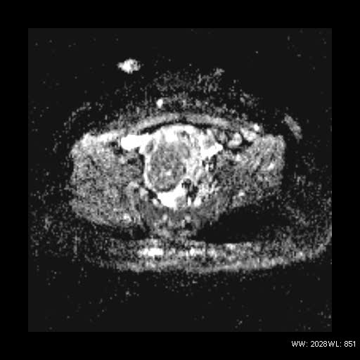 File:Broad ligament fibroid (Radiopaedia 49135-54241 Axial ADC 14).jpg