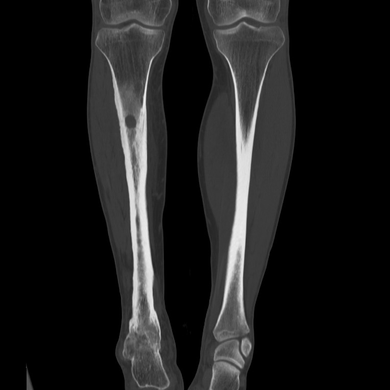 Brodie abscess - tibia (Radiopaedia 66028-75204 Coronal bone window 31).jpg