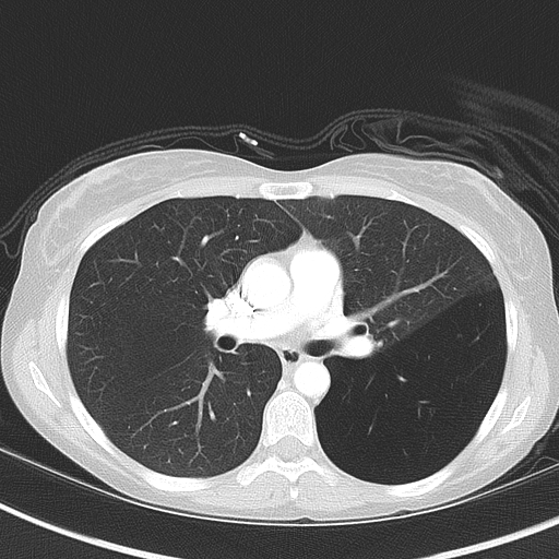 File:Bronchial atresia (Radiopaedia 73677-84470 Axial lung window 29).jpg