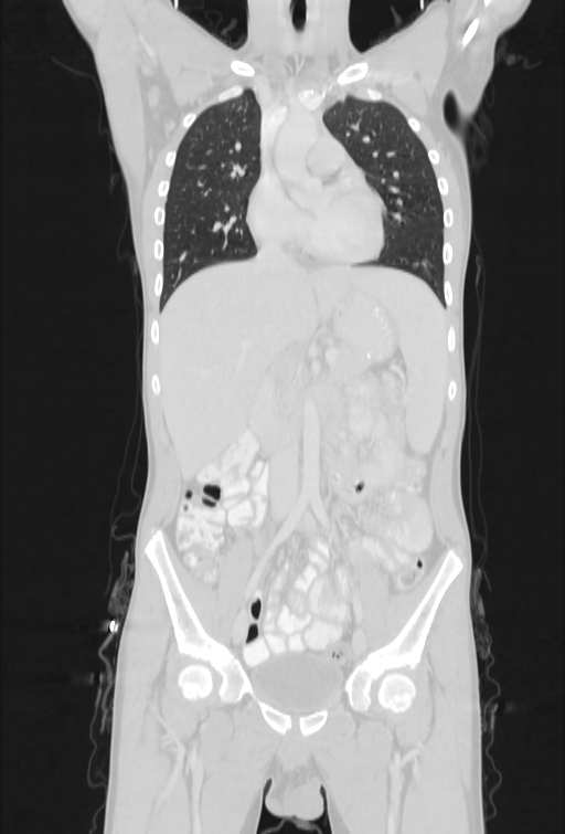 Bronchial carcinoid tumor (Radiopaedia 57187-64090 Coronal lung window 37).jpg