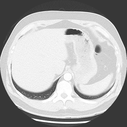 Bronchial carcinoid tumor (Radiopaedia 67377-76764 Axial lung window 55).jpg